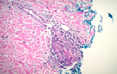 A Rare Case of AML Presenting as Leukocytoclastic Vasculitis