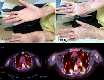 Cutaneous Squamous Cell Carcinoma and Epidermolysis Bullosa: An Unholy Alliance-Case Report and Review of The Literature