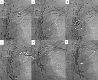 Thoracic Duct Stent-Graft Decompression in Advanced Colon Cancer Patient with Refractory Chylothorax Caused by Thoracic Duct Obstruction and Associated Hypertension