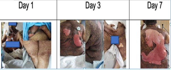 Case Report: Steven Johnson Syndrome/Toxic Epidermal Necrolysis (SJS/TEN) in a Patient with Carcinoma Breast Complicated By Sars-Cov2, Covid-19