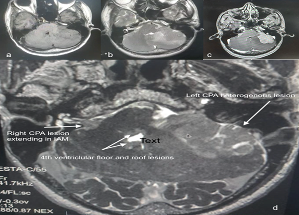 Bilateral Primary Cerebellopontine Angle Lymphoma Mimicking NF-2: A Rare Case Report with Review of Literature