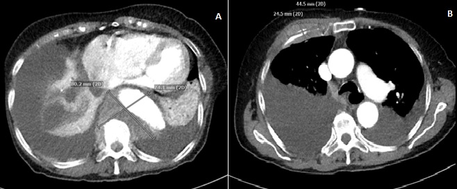 Cyclophosphamide, Bortezomib and Dexamethasone (CyBordD) for Multiple Extramedullary Plasmacytomas and Bilateral Myelomatous Pleural Effusion