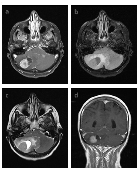 Recurrence of Ovarian Cancer with a Single Cerebellar Mass: A Case Report