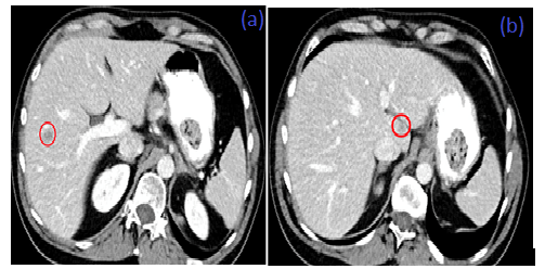 Liver Venous Deprivation for Rapid Liver Hypertrophy before major Hepatectomy: A Case Report