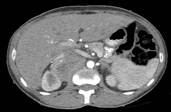 EDP Protocol For Metastatic Inoperable Pheochromocytoma: A Case Report