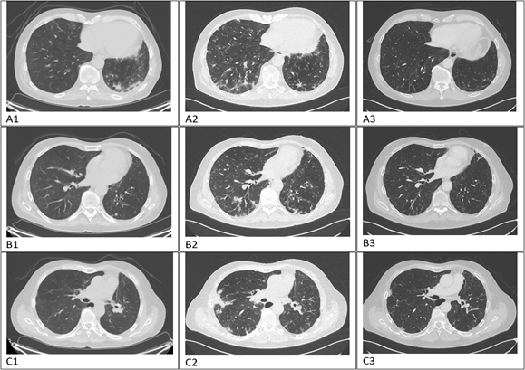 Across Differential Diagnosis between Pseudoprogression and Hyperprogression to Immunotherapy in Non-Small Cell Lung Cancer: A Case Report of Unusual Symptomatic Pseudoprogression