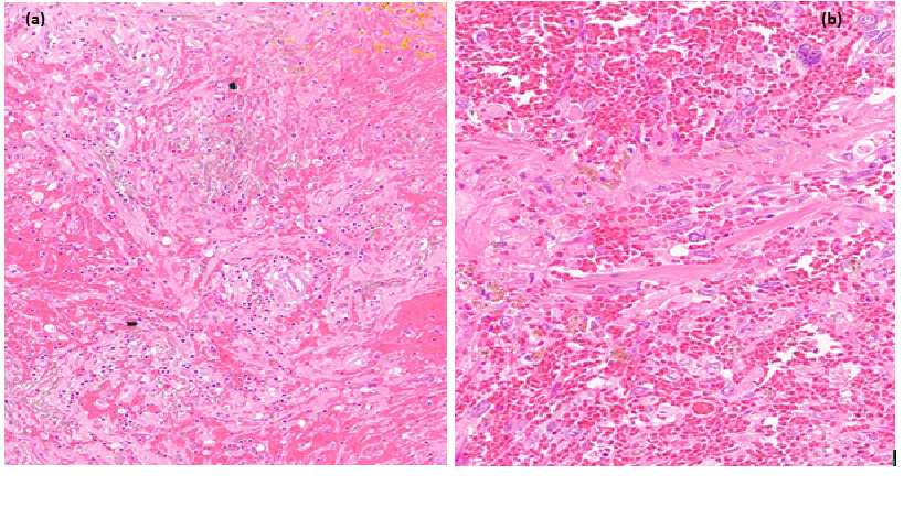 Primary Angiosarcoma Of The Spleen With Spontaneous Rupture: A Case Report