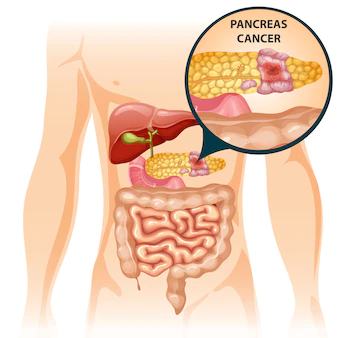 Review of Clinical Diagnosis, Epidemiology, Therapy, and Results for Pancreatic Cancer