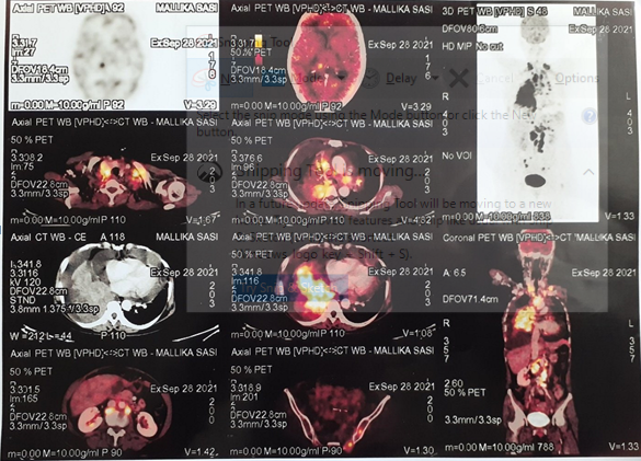 Targeted Therapy with Alectinib in Anaplastic Lymphoma Kinase Positive Metastatic Pulmonary Adenocarcinoma - A Case Report