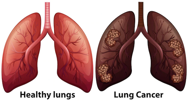 Advanced Lung Cancer Treatment Developments