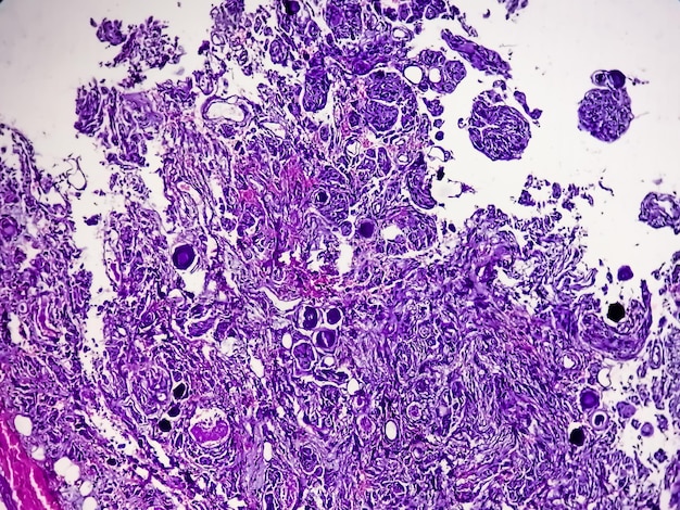 Glioblastoma: A Malignant Brain Tumour