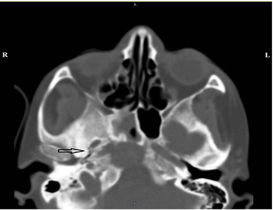 Carotid Canal: An Extremely Rare Site of Metastases from Carcinoma Breast Depicted by 18-F/ FDG PET/CT Imaging
