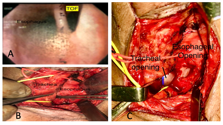 Successful Closure of the Post Tracheostomy Tracheoesophageal Fistula with Sternohyoid Muscle Interposition