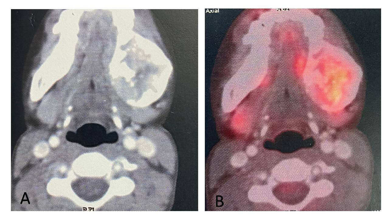 Mesenchymal Chondrosarcoma of Mandible in an 11 Year Old: A Rare Case Report