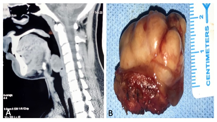 Biphasic Synovial Sarcoma of the Pyriform Fossa: Case Report