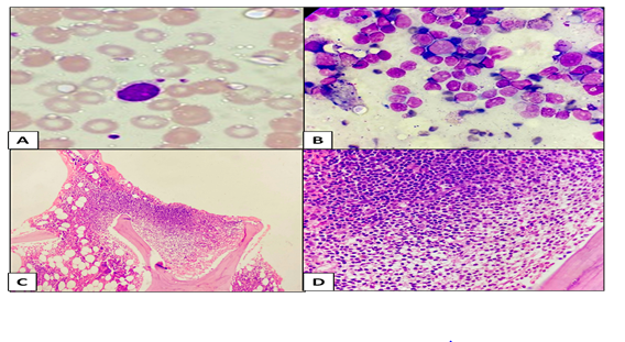 A Case of Variant Hairy Cell Leukaemia in Durable Complete Remission on Combination Therapy
