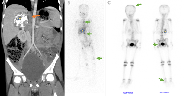 Case Report: Isolated Intramedullary Spinal Cord Relapsed Neuroblastoma - Unique Relapse Site