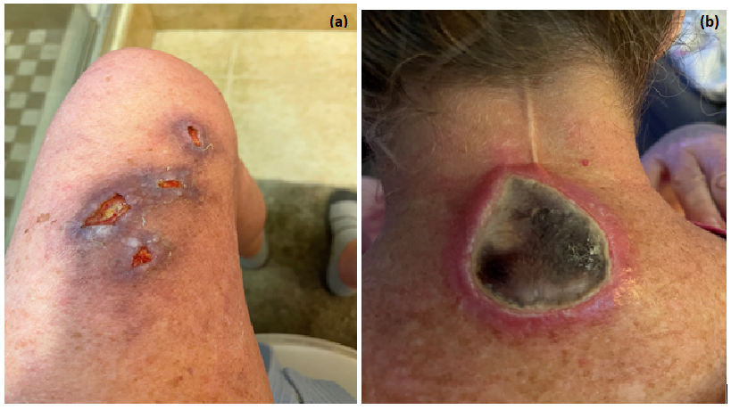 Severe photosensitivity resulting from an interaction between encorafenib and nirmatrelvir/ritonavir in a patient with advanced melanoma: A Case Report