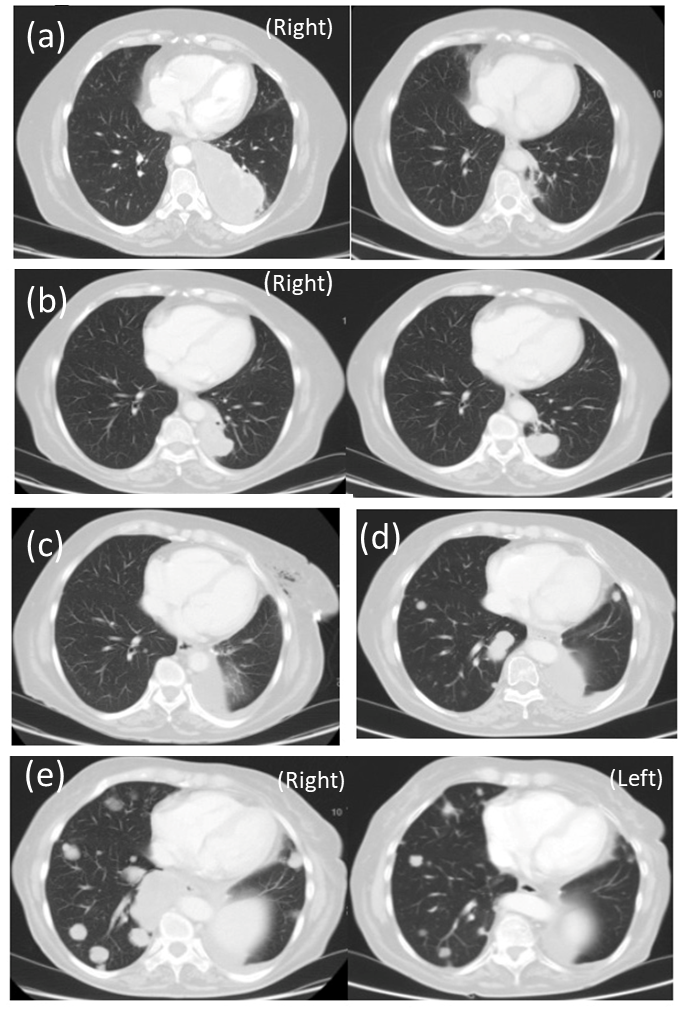 A Case Report: A Step ahead in EGFR Resistance Mechanism, Non-Small Cell Lung Cancer (NSCLC).