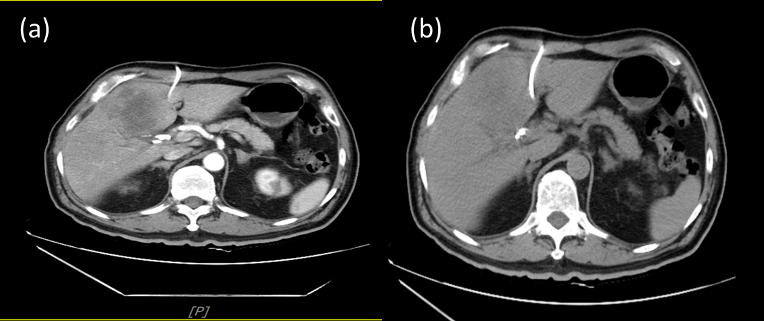 Chinese Herbal Medicine Integrated with Western Medicine Significantly Ameliorated Hyperbilirubinemia in a Patient with Metastatic Gallbladder Adenocarcinoma: A Case Report