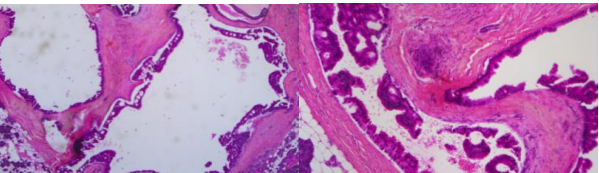 Management of Invasive Ductal Carcinoma of the Parotid Gland: A Case Report