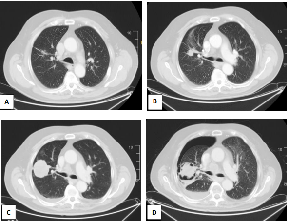 Acquired MET Exon 14 Skipping Mutation and Complex Mutations in EGFR-Mutated Lung Adenocarcinoma: A Case Report