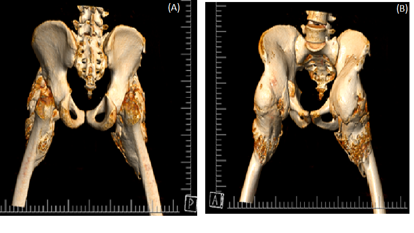 A Single Dose does Matter! An Interesting Case of Adjuvant Radiation Therapy in Heterotopic Ossification of the Bilateral Hip: A Clinical Case Report