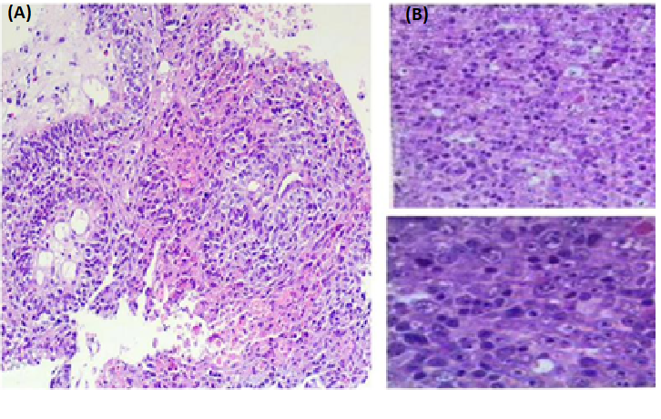 A Case Study on Two Primary Cancer of Non-Hodgkin's Lymphoma Together with Lung Squamous Cell Carcinoma