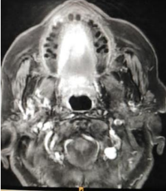 Squamous Cell Carcinoma with Verrucous Features of the Tongue: A Case  Report