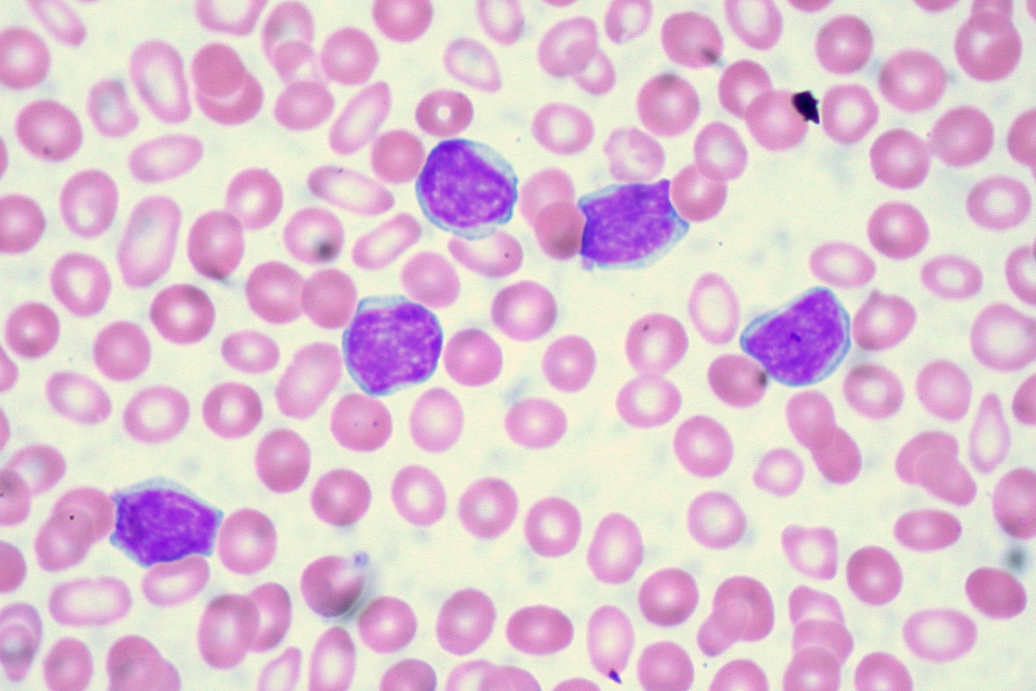 A Very Rare Case Presentation of Chronic Lymphocytic Leukemia Occurring during the Course of Chronic Myeloid Leukemia