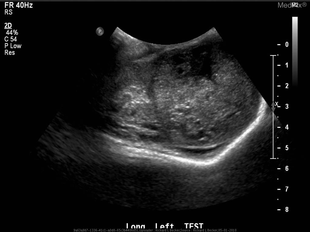 Rare Testicular Tumor Report of a Case