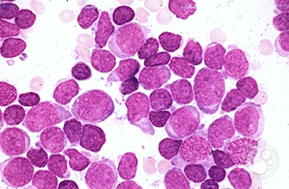 A Sole Cytogenetic Abnormality r (2) in Acute Lymphocytic Leukemia Patient: An Indian Experience