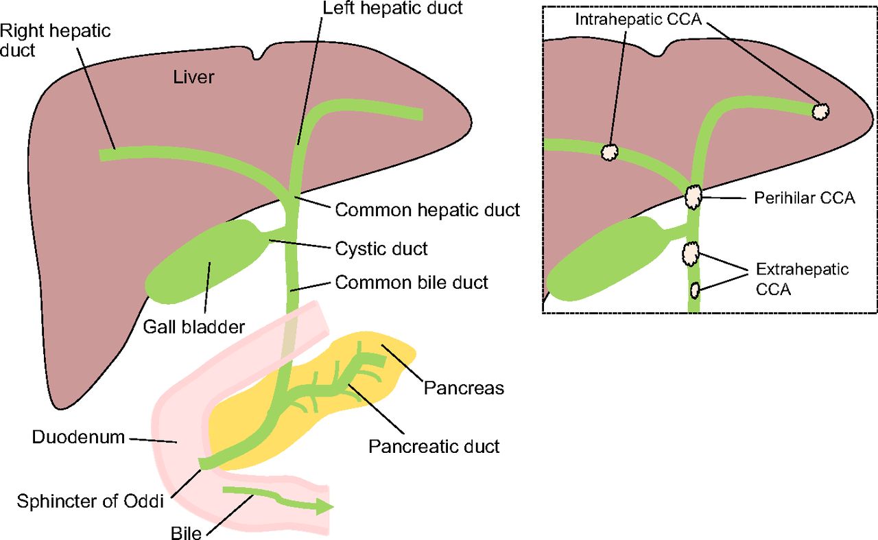 Brachytherapy Boost to Tumor Bed Prior to Adjuvant Chemoradiation in Margin Positive Resected Cholangiocarcinoma