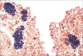 Primary Renal Angiosarcoma
with Cutaneous Metastasis to the
Skin