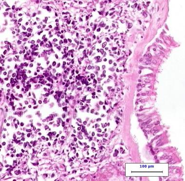 Squamous Cell Carcinoma of the Esophagus after Adalimumab Treatment for Psoriatic Arthritis from Human Papillomavirus Activation