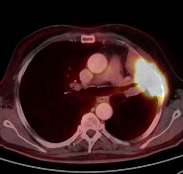 Localized Amyloidosis of the
Nasopharnx, a Role for Modern
Radiotherapy, a Case Report and
Literature Review