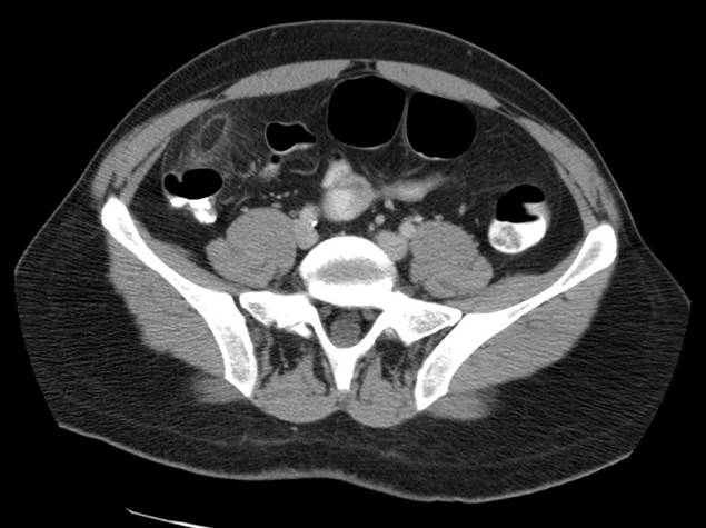 A Case of Plasmacytoid Bladder Cancer Relapsing with Linitis Plastica of the Colon and Rectum