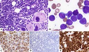 Isochromosome i(9)(q10): A Rare Chromosomal Aberration in B-cell Acute Lymphoblastic Leukemia