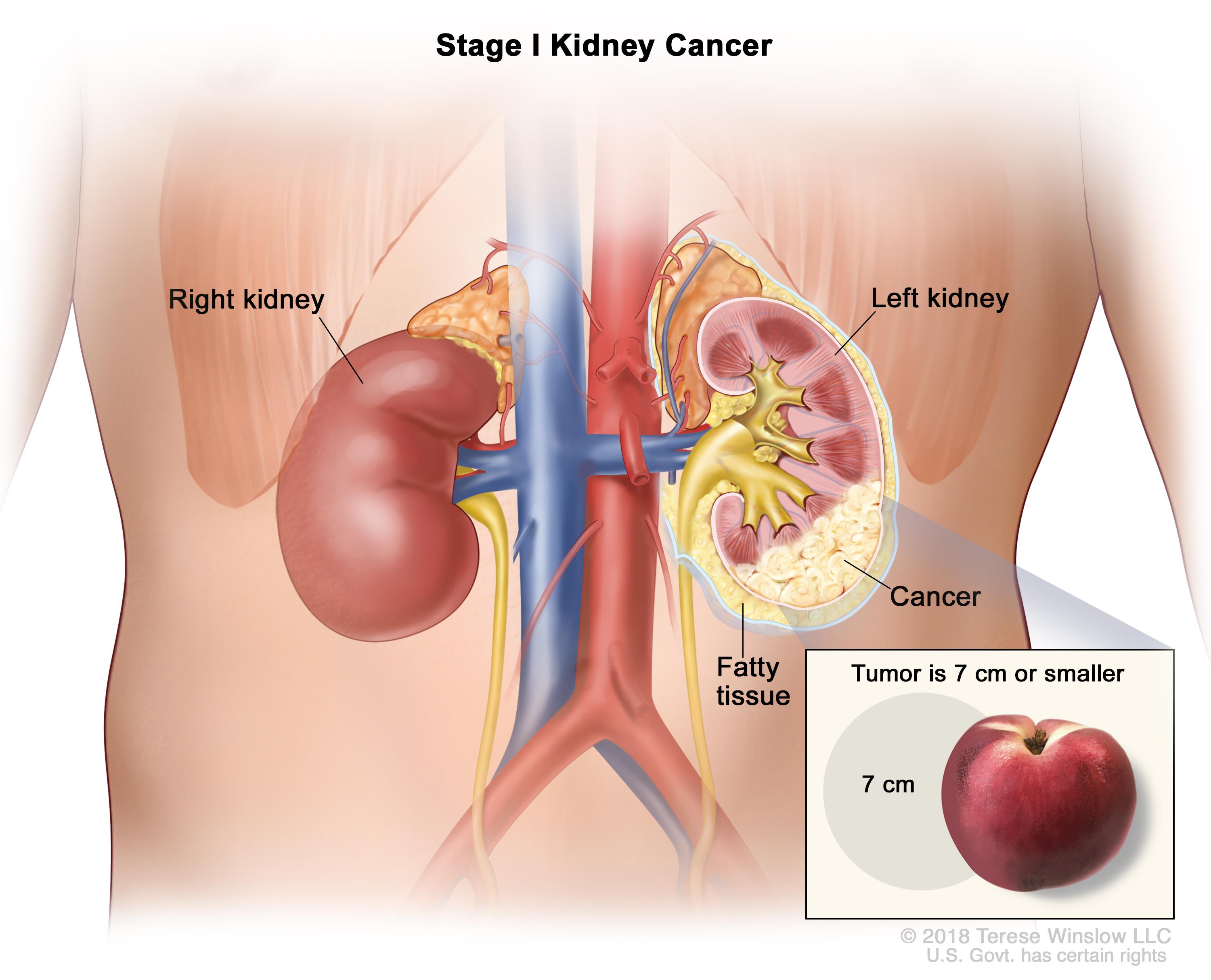 A Dramatic Response to Immune Checkpoint Inhibitor in a Patient with a Bulky Intra Cardiac Metastasis in Renal Cell Carcinoma: A Case Report