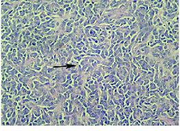 Pancreatic Extraskeletal Ewing Sarcoma/Primitive Neuroectodermal Tumor: Case Report of a Rare Pathology