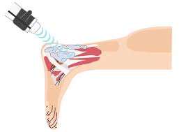 Novel of Extracorporeal Shockwave Therapy and High-Power Laser Therapy in Musculoskeletal Pain Conditions