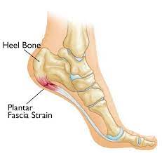 Shock Wave Therapy Effectiveness in Treating Patients with Heel Pain: A Randomized Control Trial