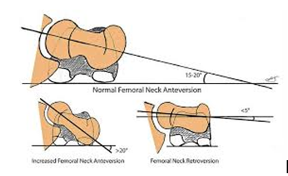 An Excel-Based Tool for Simplified Three-Dimensional Measurement of Femoral Neck Anteversion