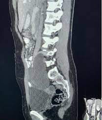 Osteoplastic Laminectomy for Resection of a Ganglioneuroma at the Sacral Spine