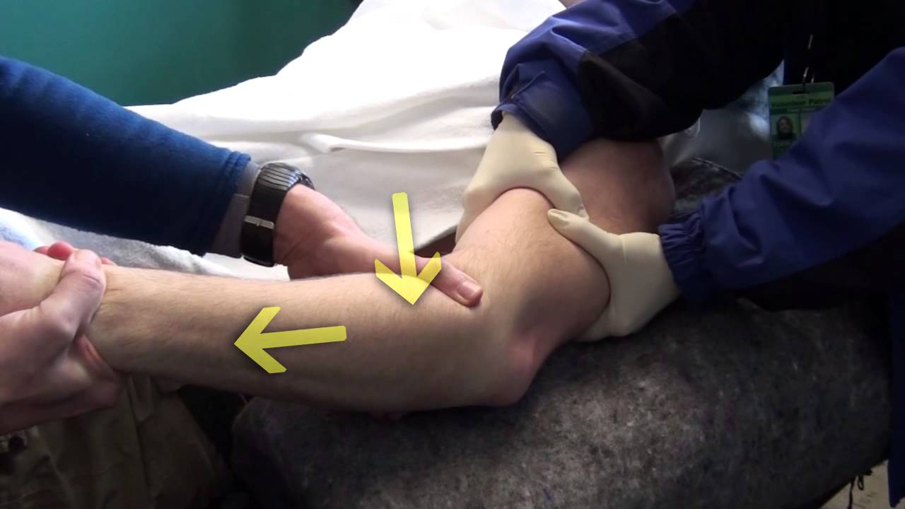 Acute Severe Valgus Instability without Elbow Dislocation