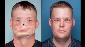 Current and Future Options of Regeneration Methods and Reconstructive Surgery of the Facial Skeleton