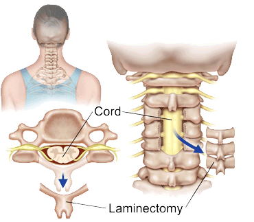 C1 Plumb Line and Cervical Sagittal Balance Predict the Outcome of Cervical Laminectomy and Fusion