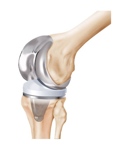 Intraarticular Bupivacaine and Epinephrine Do Not Save Blood in Primary Total Knee Arthroplasty without Drains