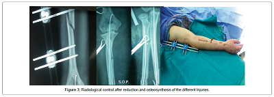 Floating Dislocated Elbow in adults: A Case Report