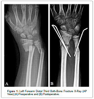 Heterotopic Ossification- Induced Osteomyelitis 3 Years after a Closed Both-Bone Forearm Fracture in a Pediatric Patient: A Case Study